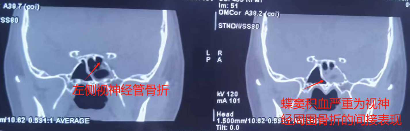 女子骑车摔倒后，黑眼珠变大却看不见了，福州爱尔眼科医院医生紧急行“减压”手术