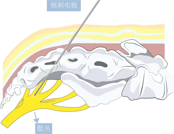 庆祝全球首例六触点骶神经调控（SacralStim）手术在中国康复研究中心顺利开展
