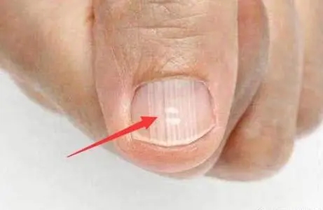 指甲有竖纹是身体的什么信号？指甲出现竖纹我们应该怎样做，调理方法是什么
