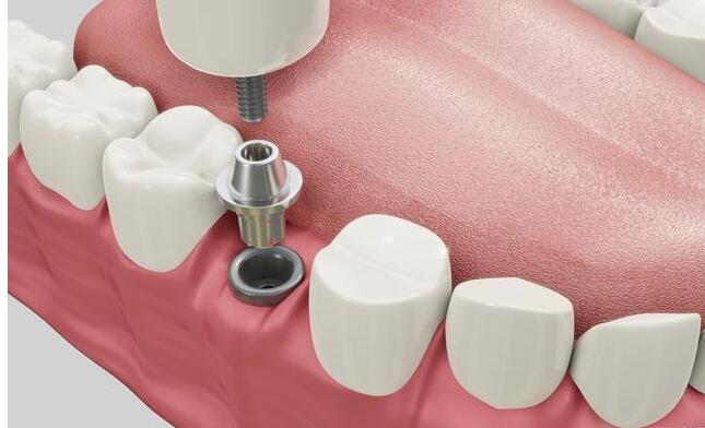种植牙万元时代即将结束，平均降幅达到了45%，口腔患者的福音！