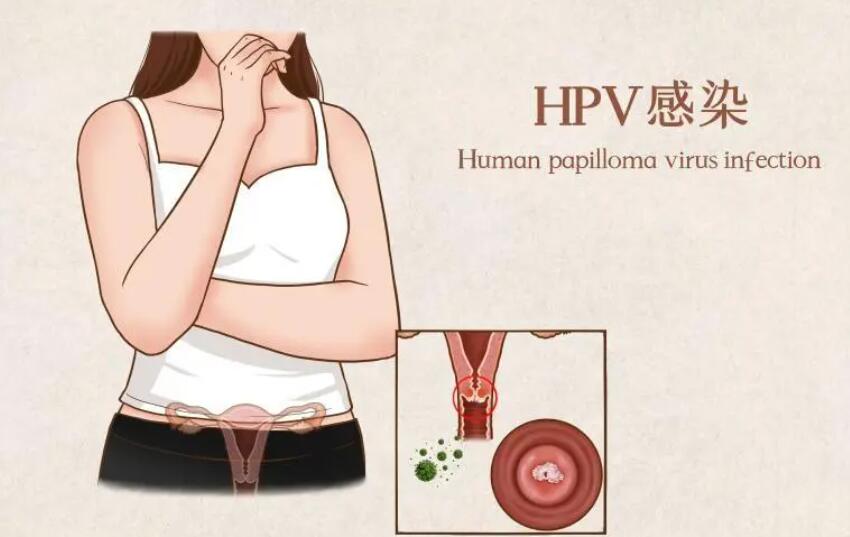 hpv是什么病，HPV有哪些特点，它的治疗方法有哪些？