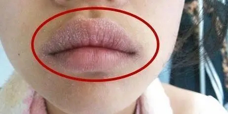 嘴唇干裂起皮什么原因造成的？生活中不注意这两点，多喝热水也没有用