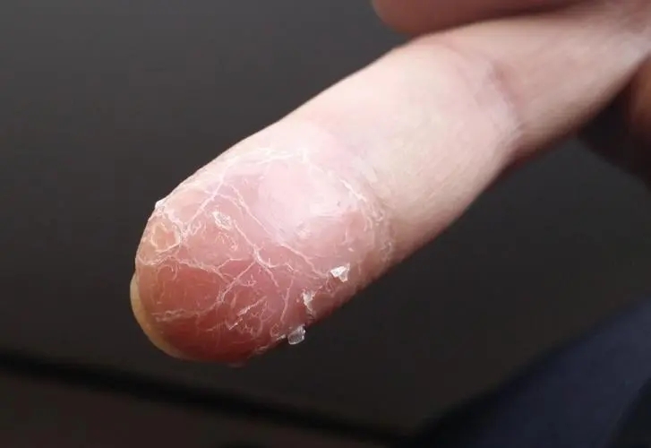 手指头脱皮是什么原因？这三个原因都会导致，看完赶紧自查一下