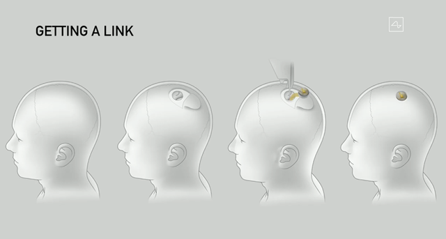 重磅！马斯克旗下脑机接口公司Neuralink官宣：首次人体临床试验获FDA批准